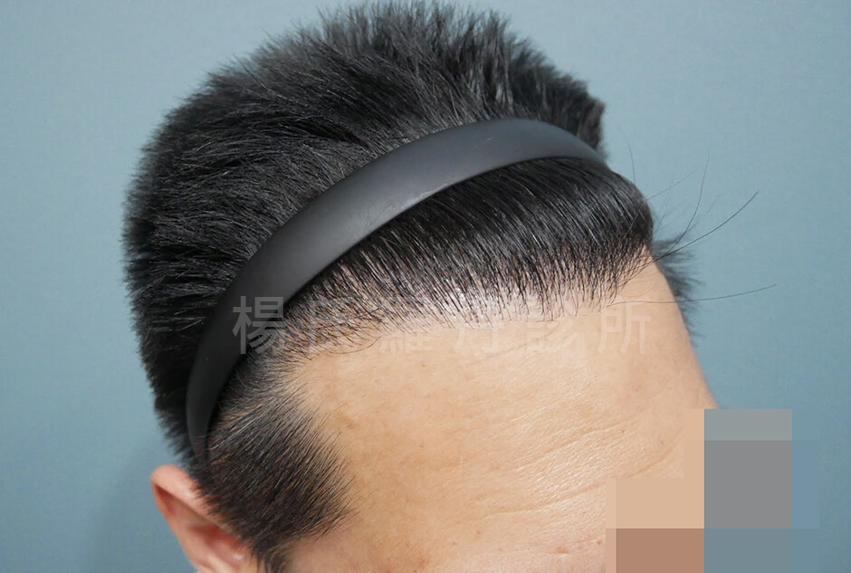 植髮 植髮成果