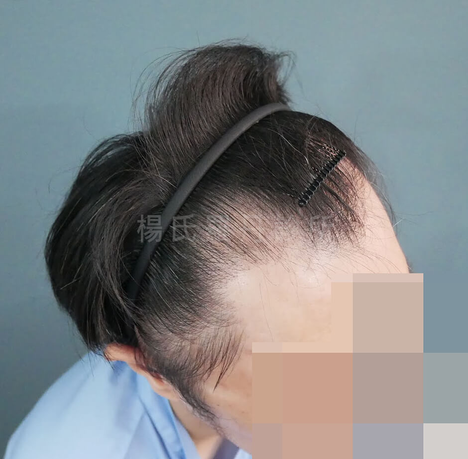 植髮 髮際線 