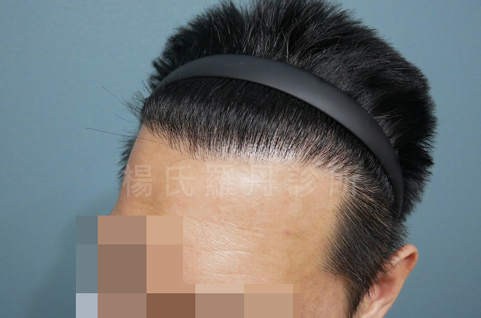 植髮 植髮案例