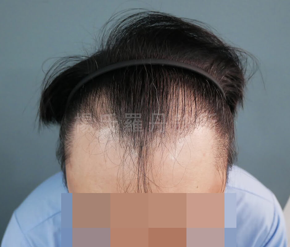 植髮 髮際線植髮