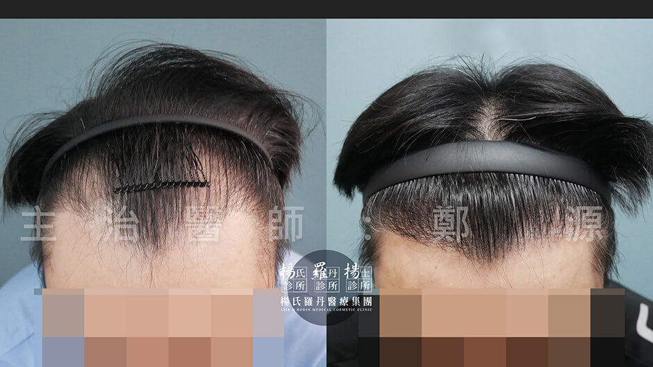 植髮 髮際線植髮 髮際線