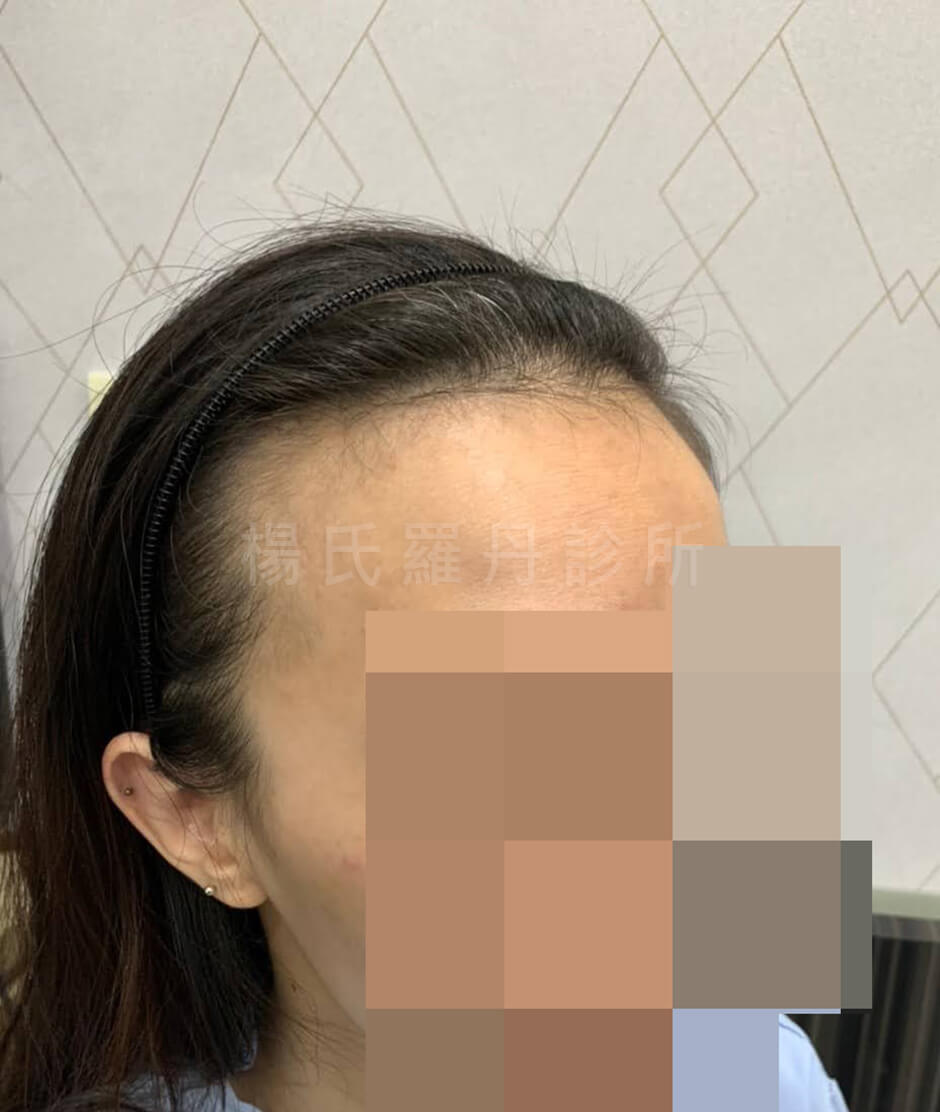 植髮 髮際線  女性植髮