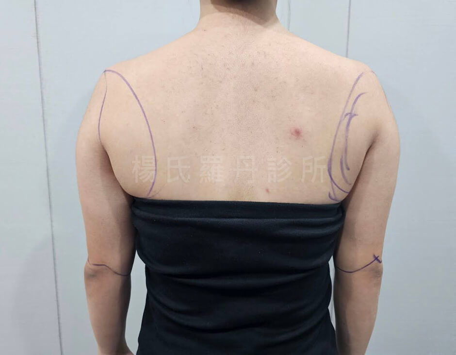 雷射減脂 減脂 雕塑