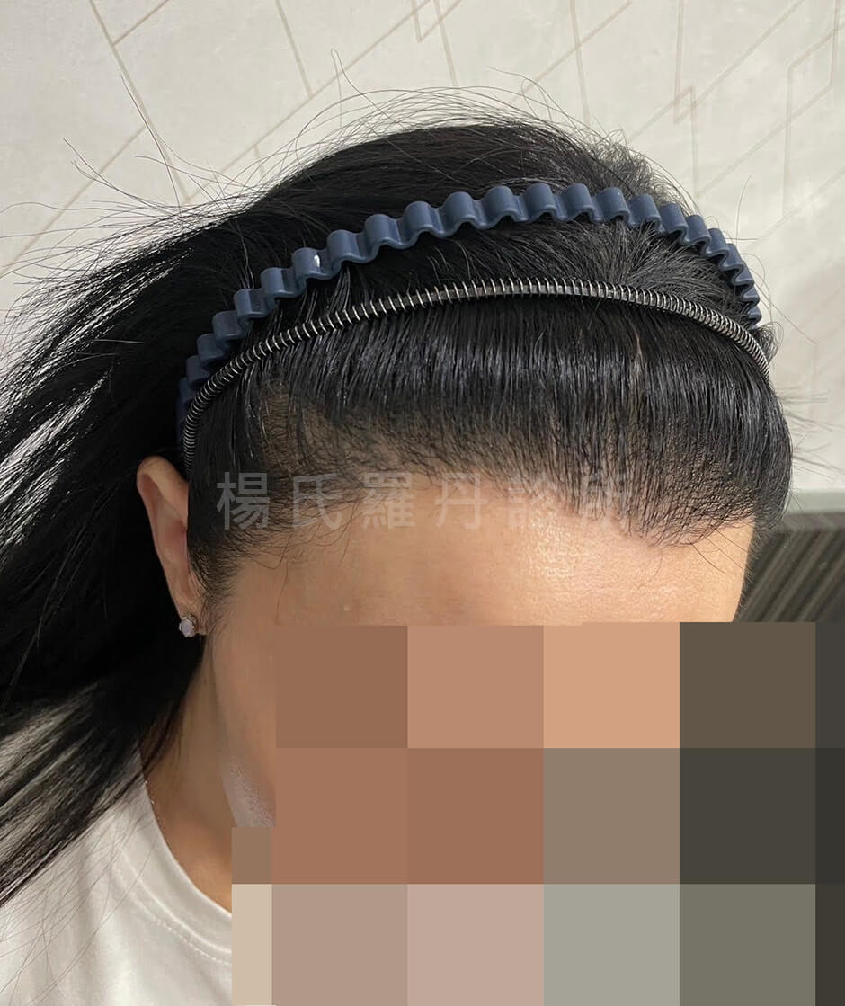 女性髮際線 植髮 美型植髮
