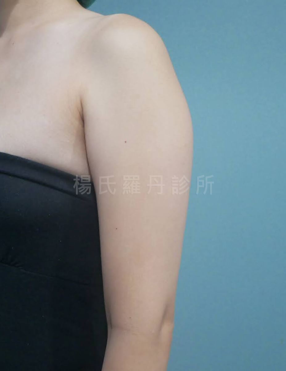 手臂抽脂 抽脂