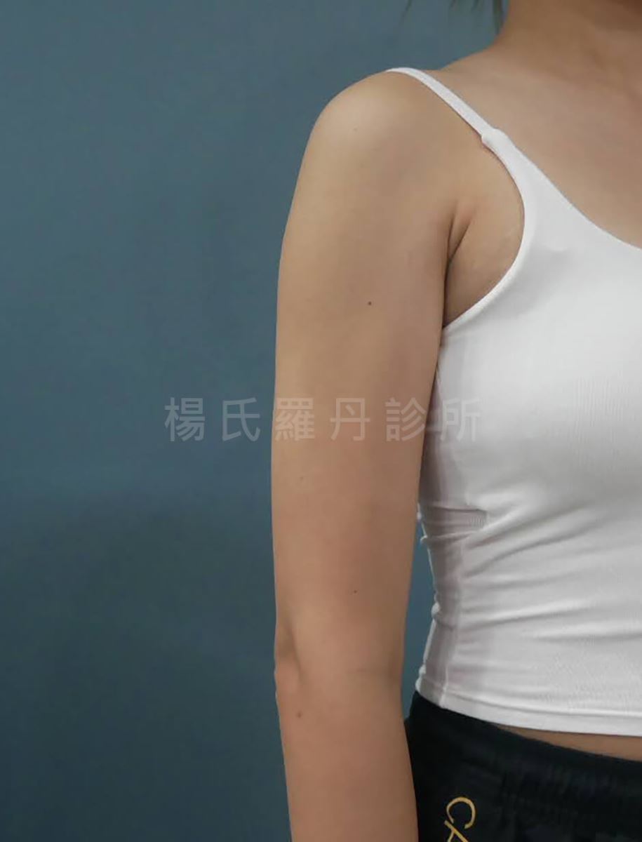手臂抽脂 蝴蝶袖