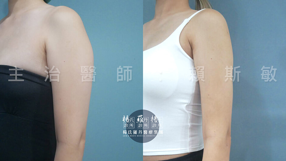 手臂抽脂 抽脂 雷射減脂 