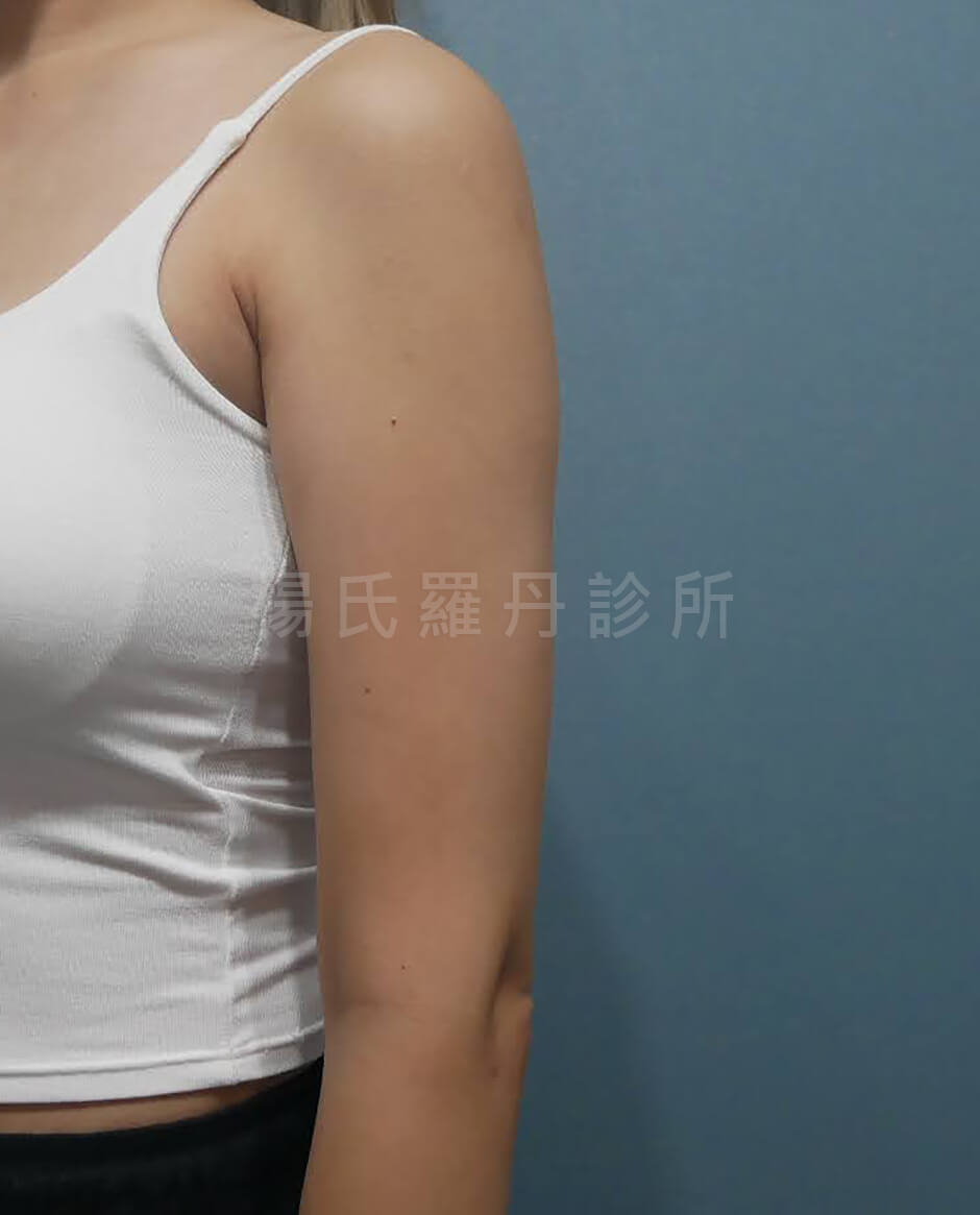 手臂抽脂 雷射減脂