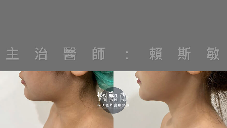 減脂 減脂手術 瘦下巴