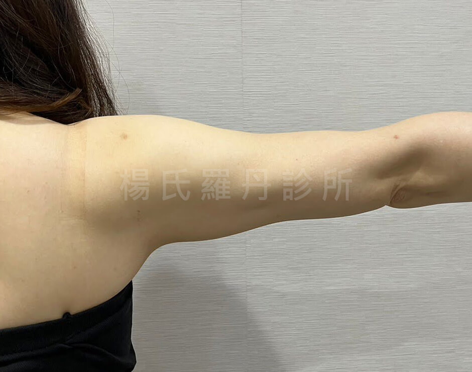 減脂 雷射減脂 雕塑