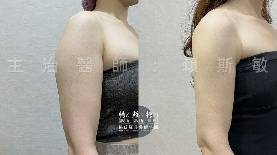 手臂抽脂 雷射減脂 抽脂