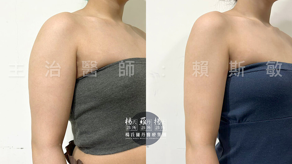 手臂抽脂 雷射減脂 瘦手臂