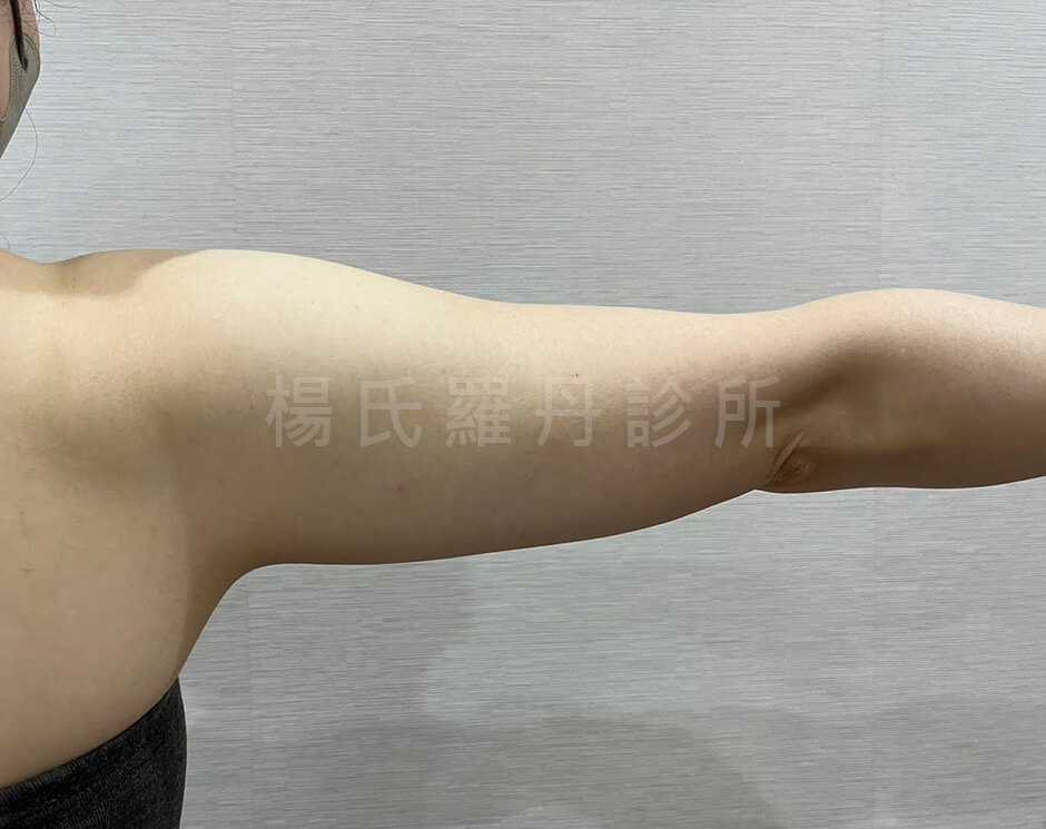 手臂抽脂 瘦手臂