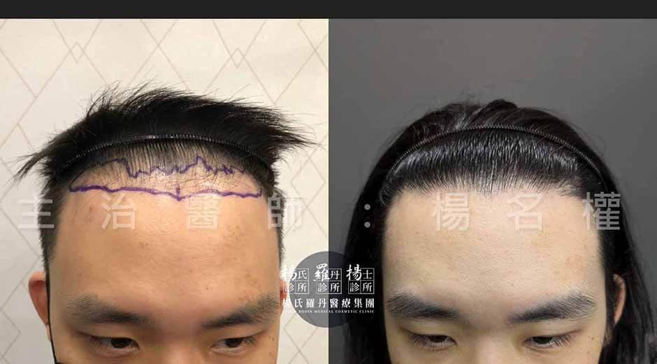 植髮 植髮案例 植髮診所
