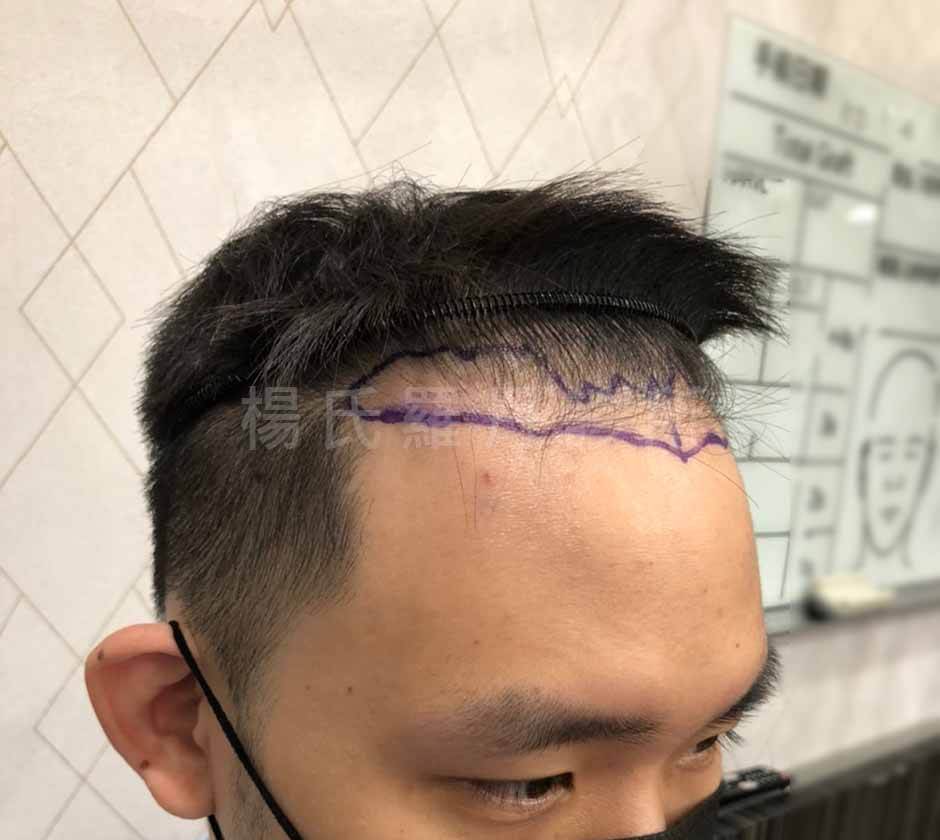 植髮 植髮效果