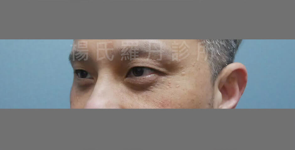 眼袋手術 淚溝