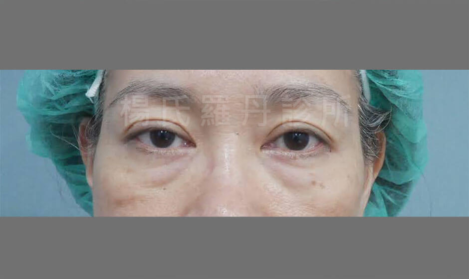 眼袋手術 眼袋