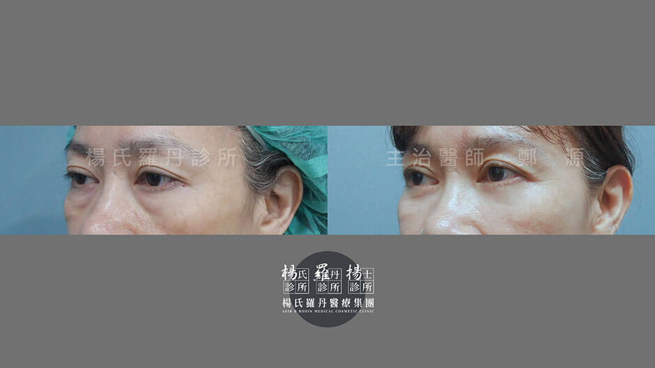 眼袋手術 眼袋消除 眼袋