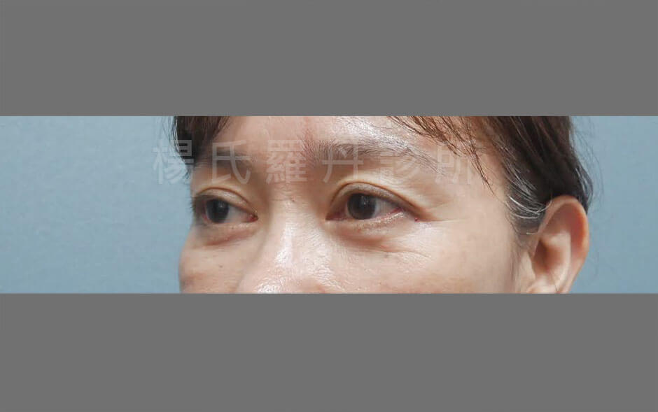 眼袋手術 眼袋內開