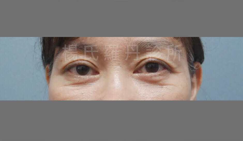 眼袋手術 除眼袋