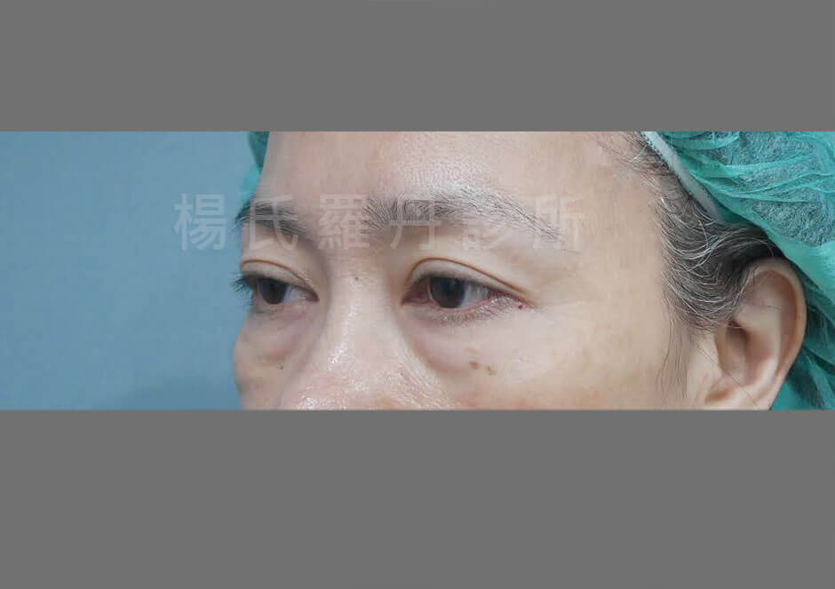 眼袋手術 眼袋消除