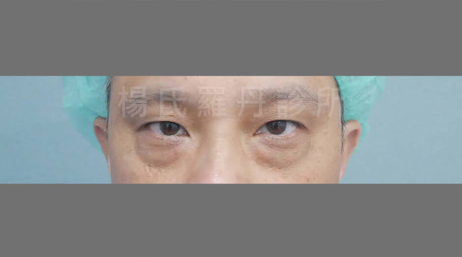眼袋手術 眼袋