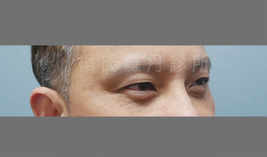 除眼袋 眼袋手術