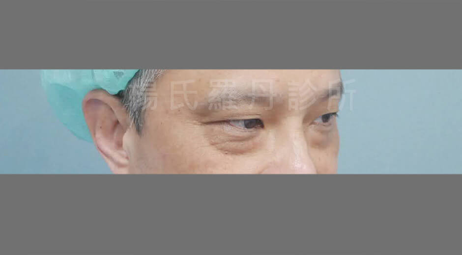 眼袋手術 眼袋內開