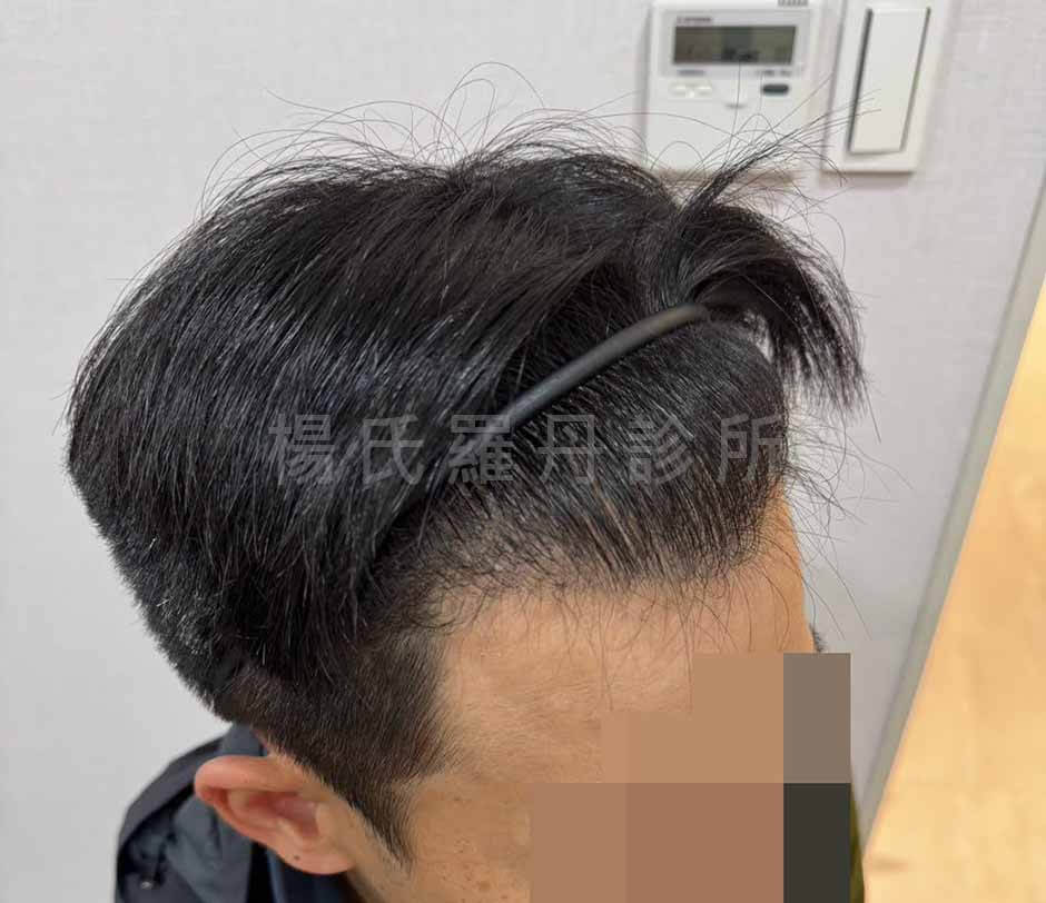 植髮 髮際線 掉髮