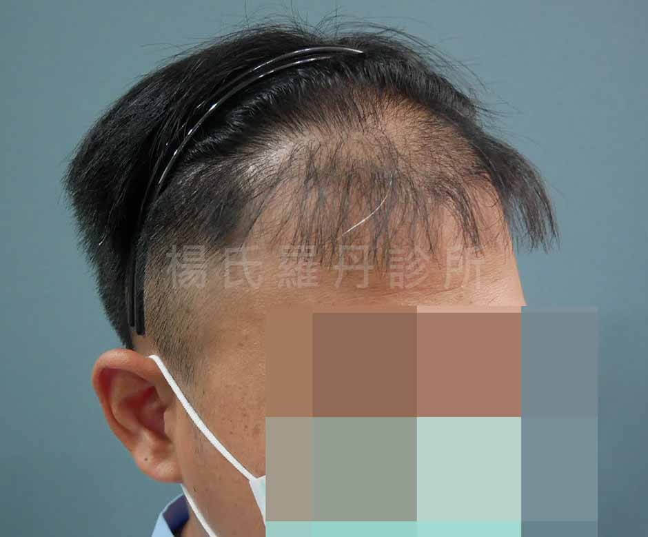 植髮 植髮手術