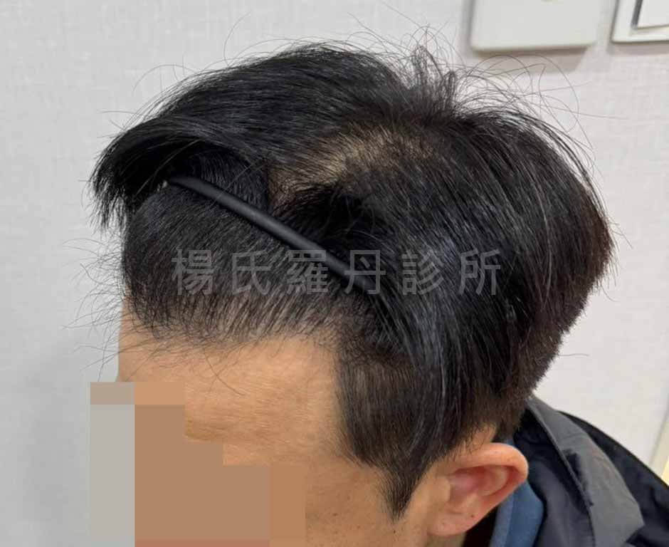 植髮 植髮成果