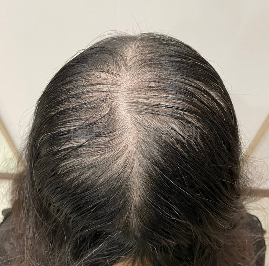 生髮 女性雄性禿