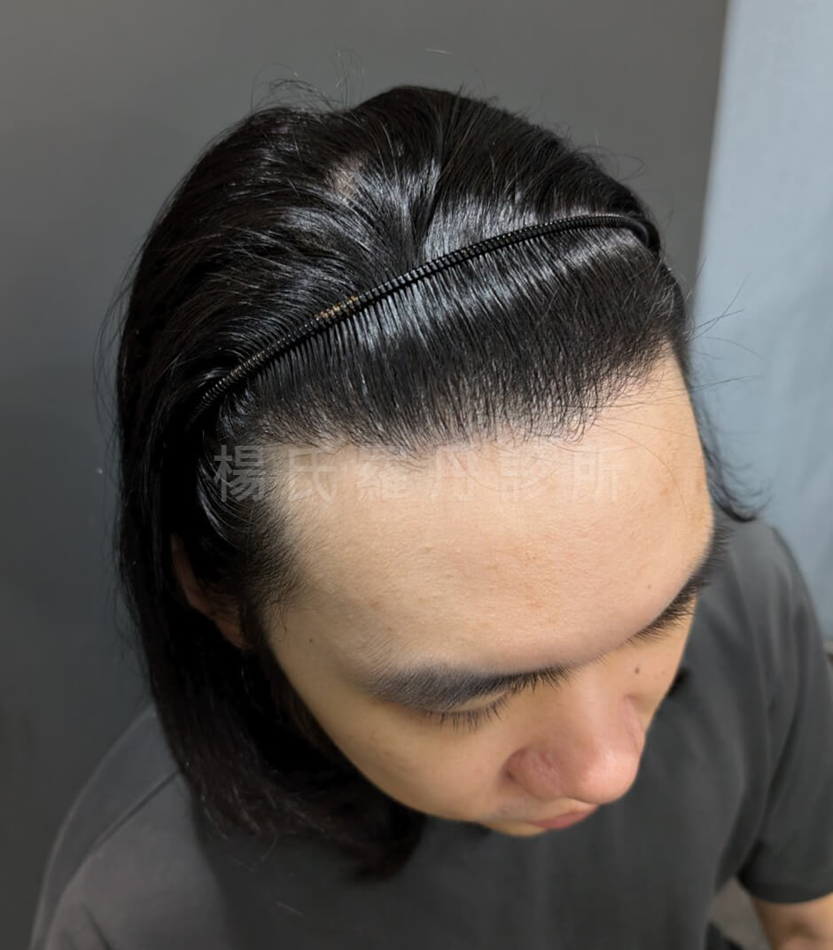 植髮 落髮