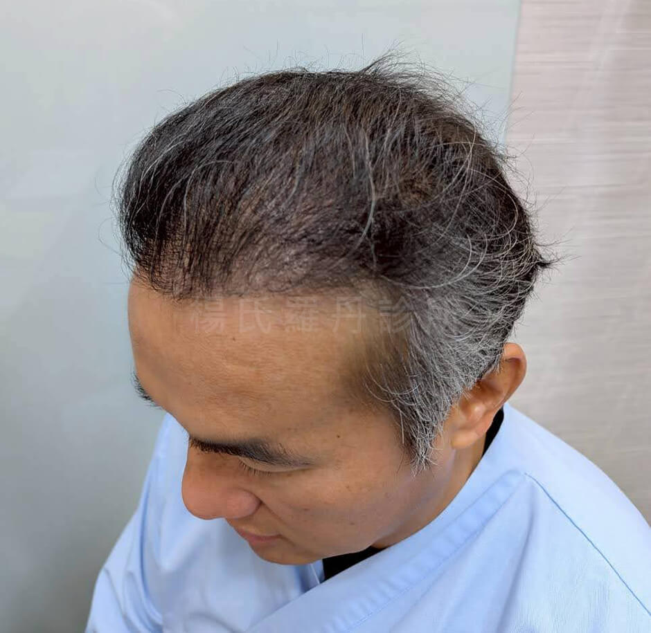 張泰山 楊氏羅丹 張泰山植髮費用