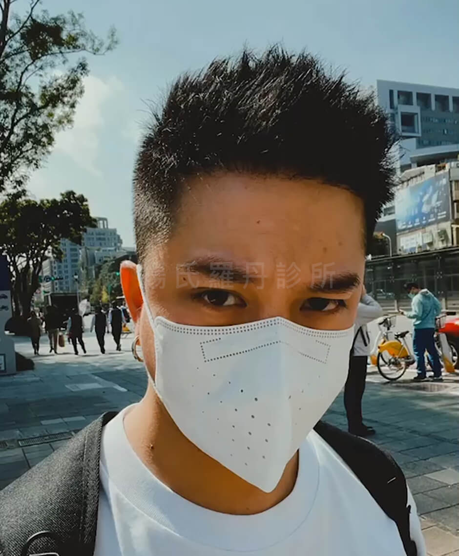 植髮 黃遠 植鬍 