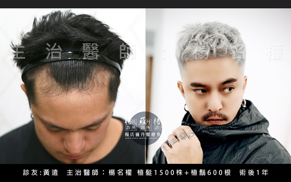 植髮 美型植髮 植鬍