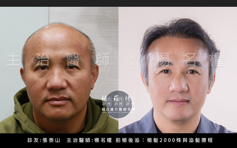 張泰山 植髮
