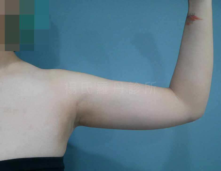 手臂抽脂 楊氏羅丹