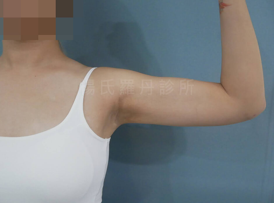 手臂抽脂 羅丹診所