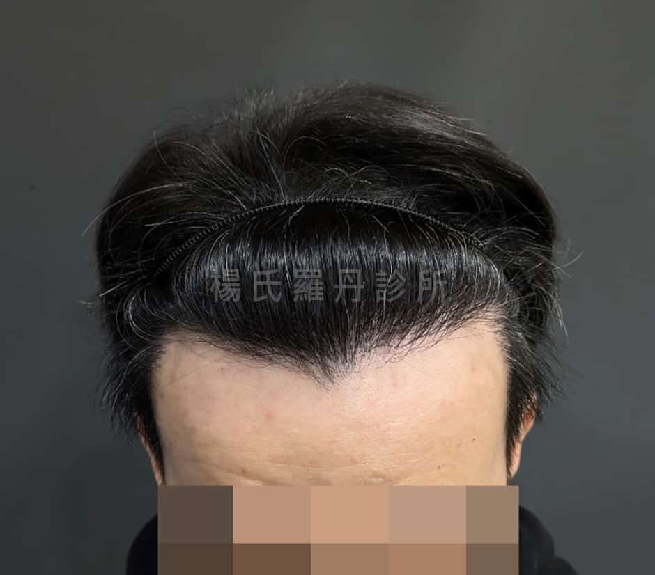 植髮 植髮案例