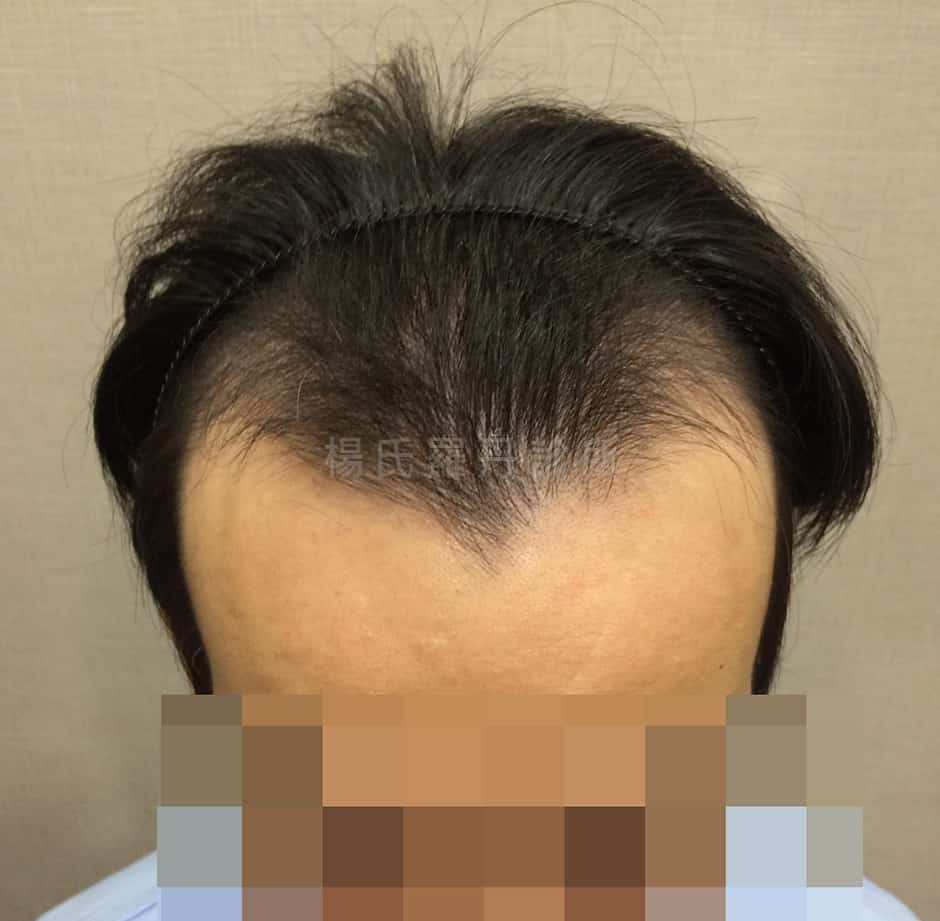 植髮 植髮效果 