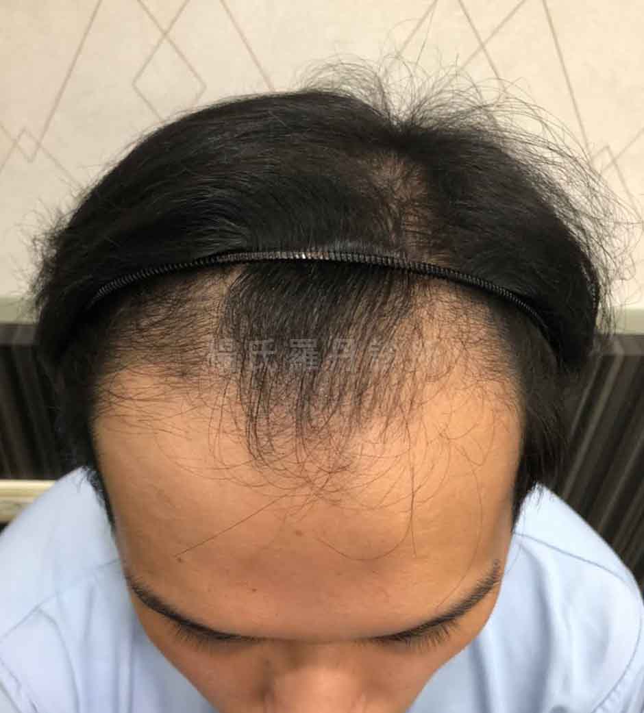 植髮 植髮案例