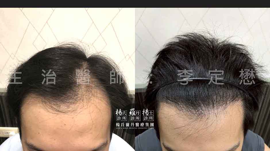 植髮 植髮案例 植髮推薦