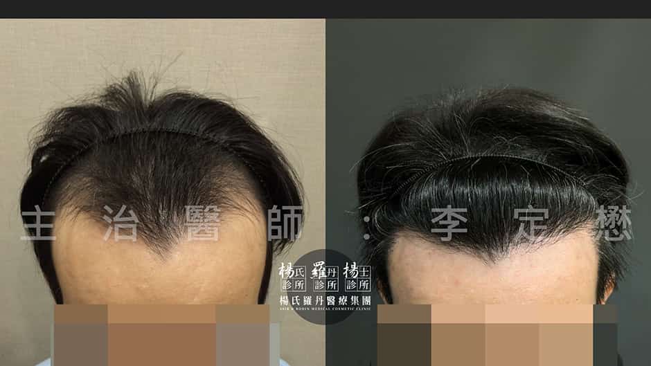 植髮 植髮推薦 植髮費用