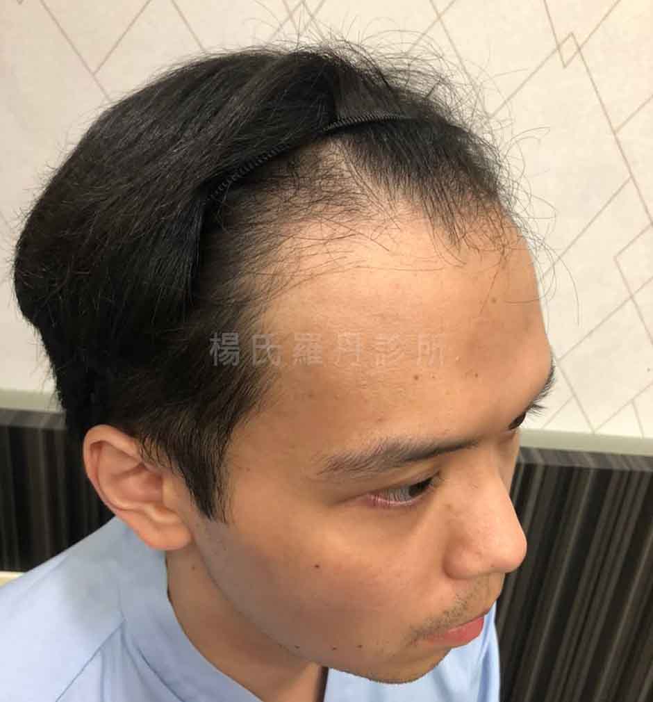 植髮 禿頭