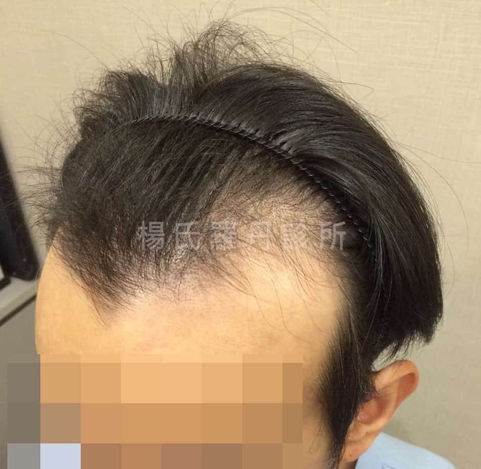 植髮 植髮手術