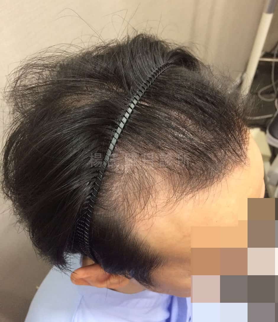 植髮 落髮