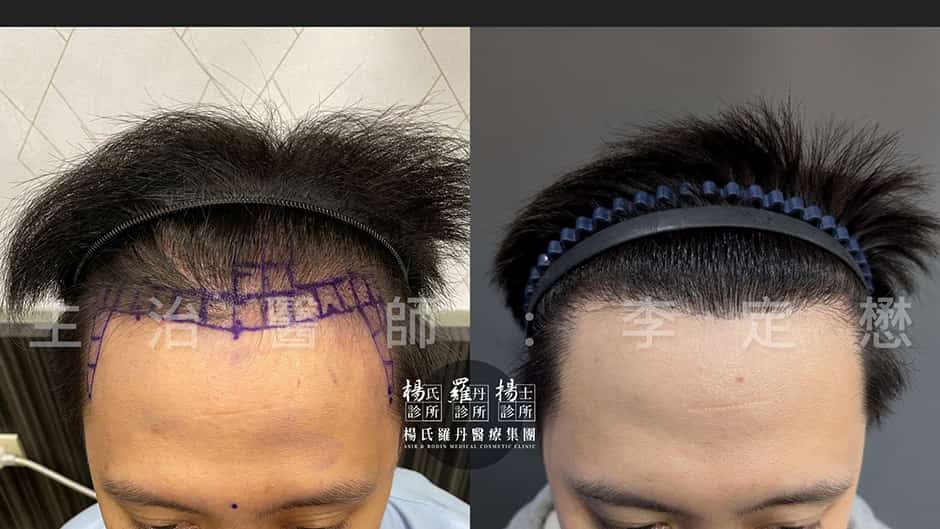 植髮 植髮案例 髮際線植髮