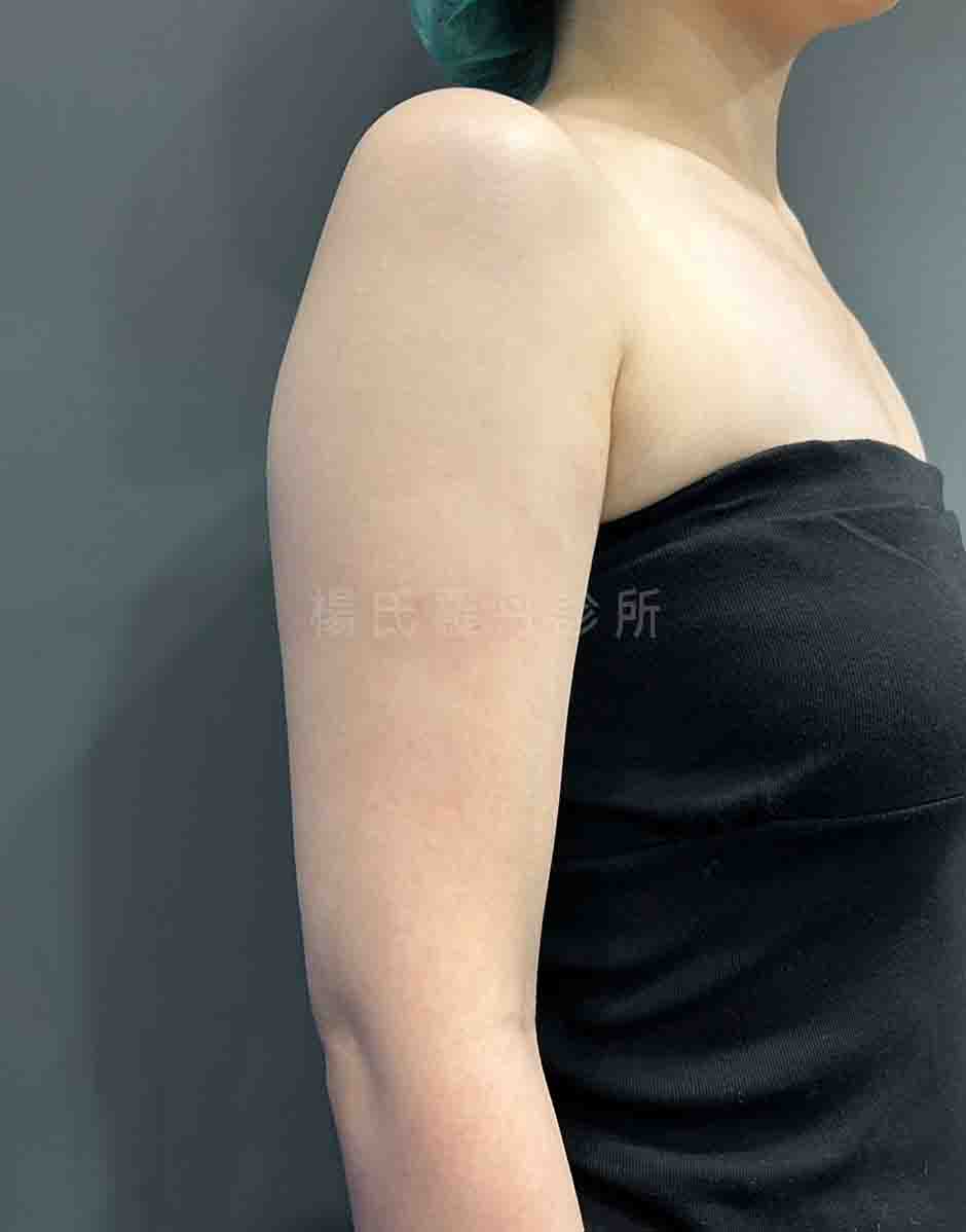 手臂抽脂 雷射減脂