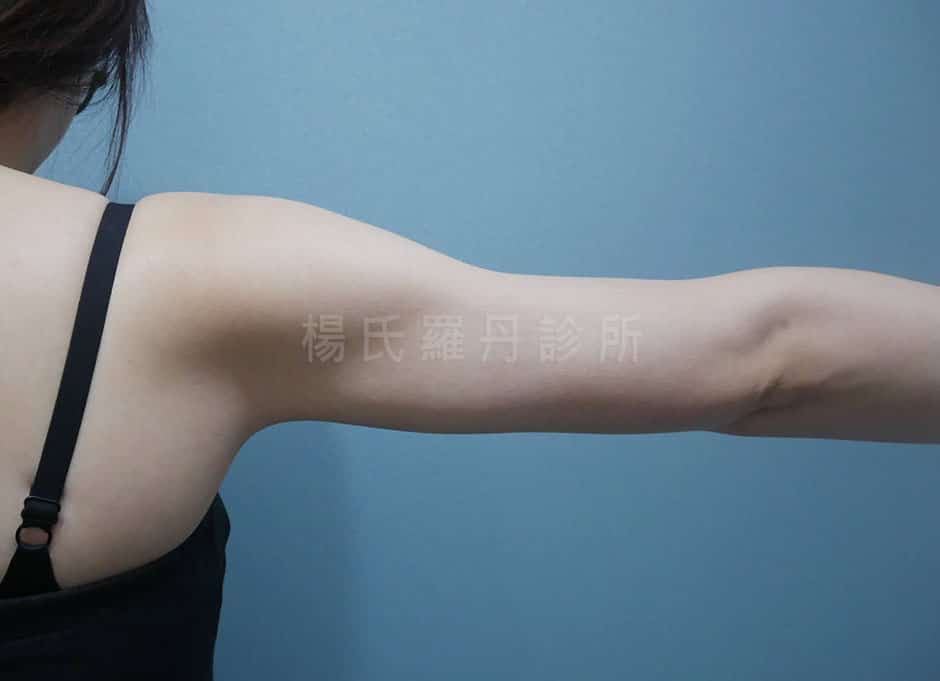 手臂抽脂 雷射減脂